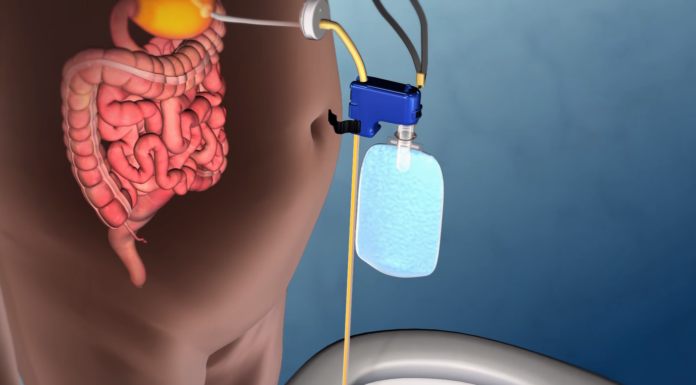 Новий революційний спосіб схуднення AspireAssist. Або повертаємося до часів Нерона