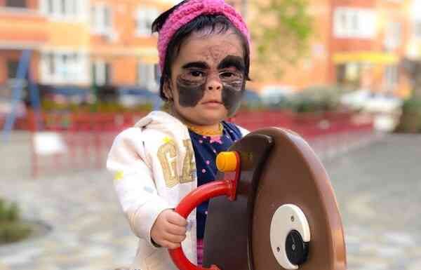 Трирічну американку з “маскою бетмена” змогли вилікувати в росії: фото до і після