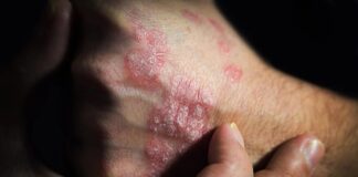 Psoriasis Flares: Why Your Skin “Remembers” Problem Spots