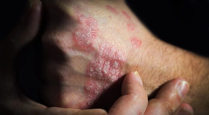 Загострення псоріазу: Чому ваша шкіра “пам’ятає” проблемні ділянки
