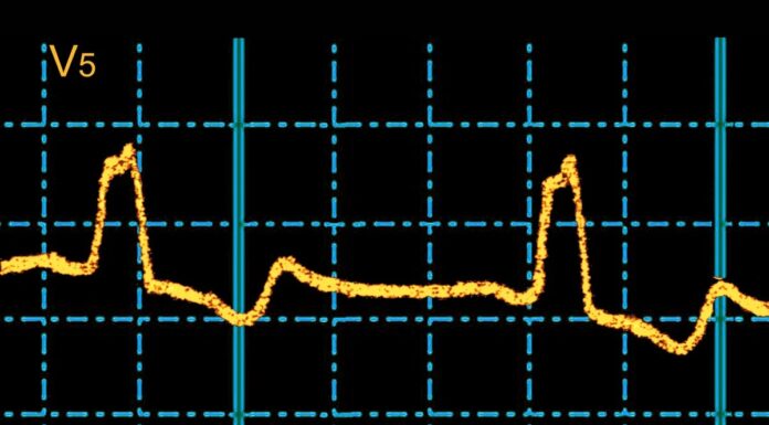 Het spooksignaal in uw ECG